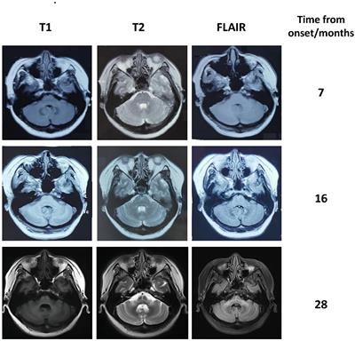 The “hot cross bun sign” in patients with autoimmune cerebellar ataxia: A case report and literature review